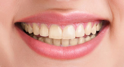 before-after-teeth-whitening-(1)
